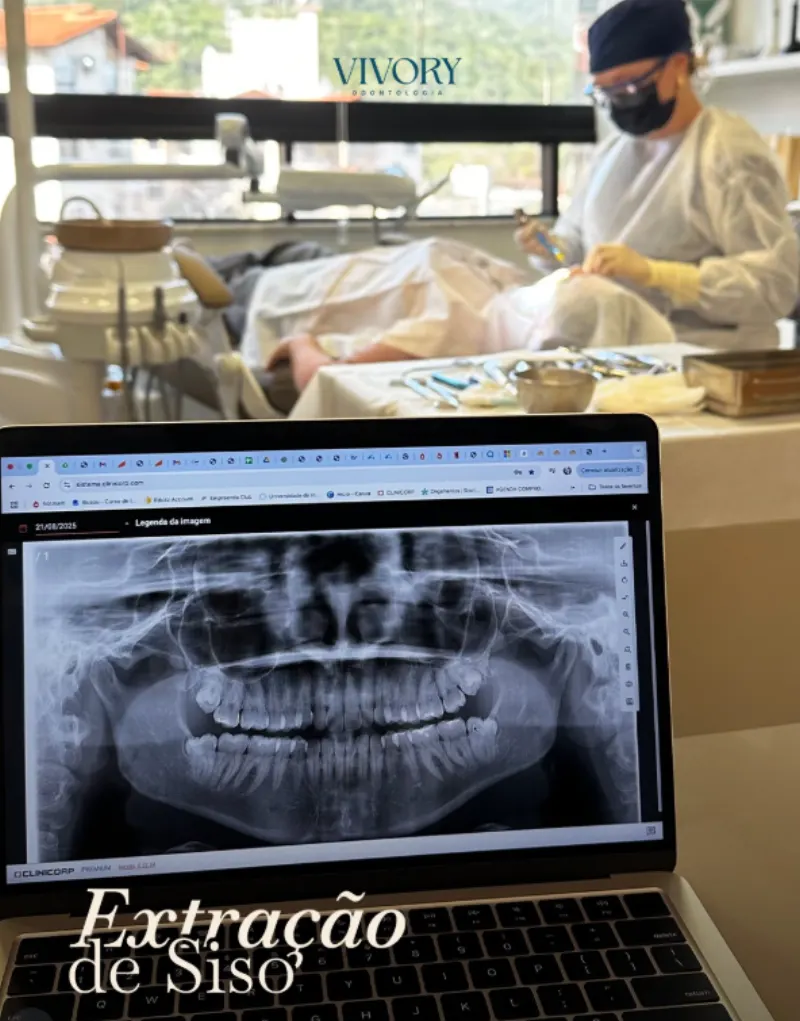Extração de Siso — radiografia panorâmica